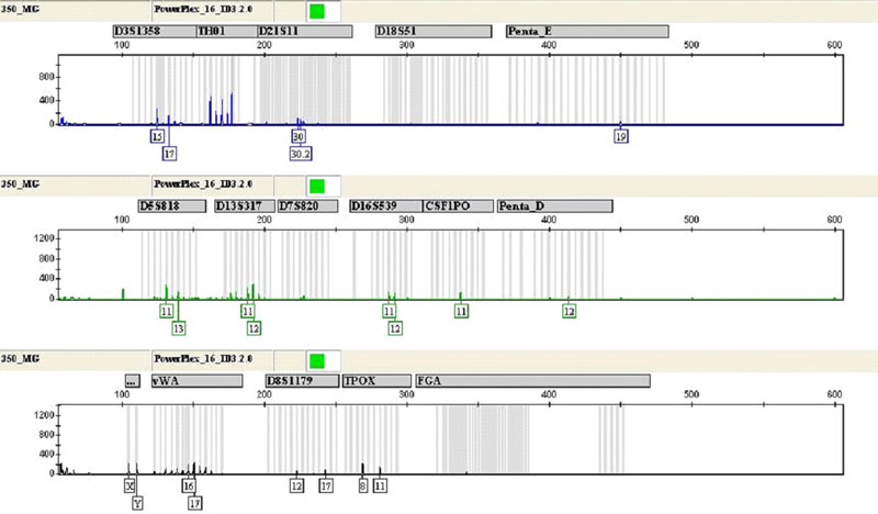 Genotype of cadaver bones buried for 50 years obtained using the PowerPlex 16 HS System.